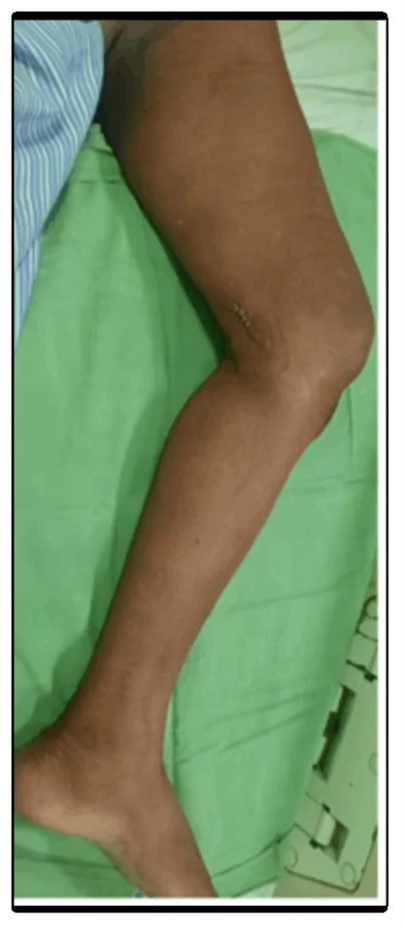 Endoscopic Vein Harvest minimal incision by Dr. Chaitanya
