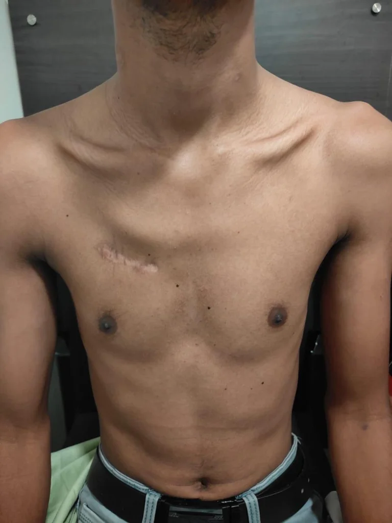 Young patient showing healed keyhole cardiac surgery scar