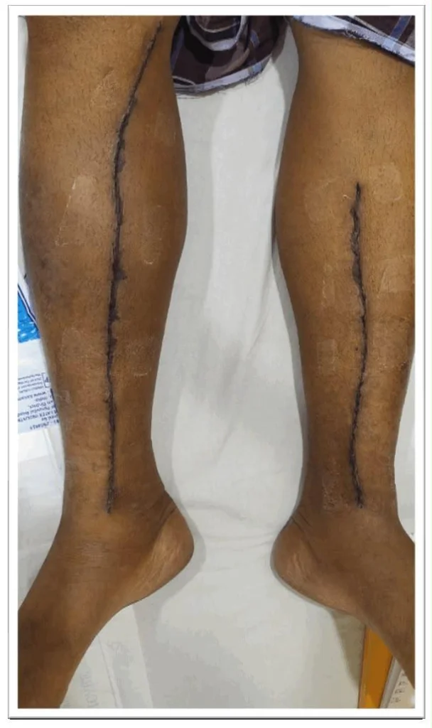 Conventional long leg incision for bypass vein harvest
